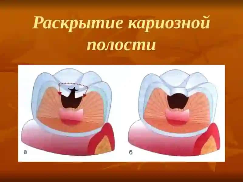 Лечение кариеса зубов по стадиям 4