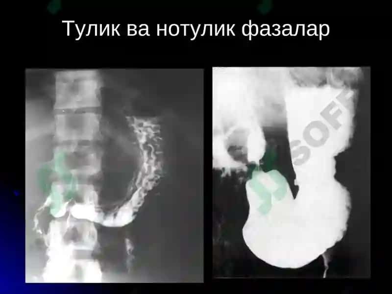 ОШКОЗОН-ИЧАК КАСАЛЛИКЛАРИ НУР ТАШХИСИ 4