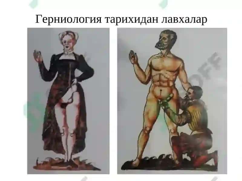 Қорин чурраларива унинг асоратлари 4