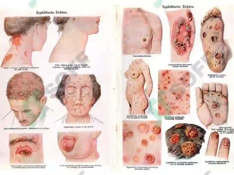 zaxm diagnostikasi - захм диагностикаси 4
