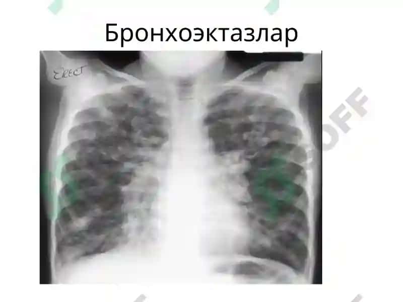 Бронхоэктазлар ва ўпка абсцесслари рентгенограммалари 4