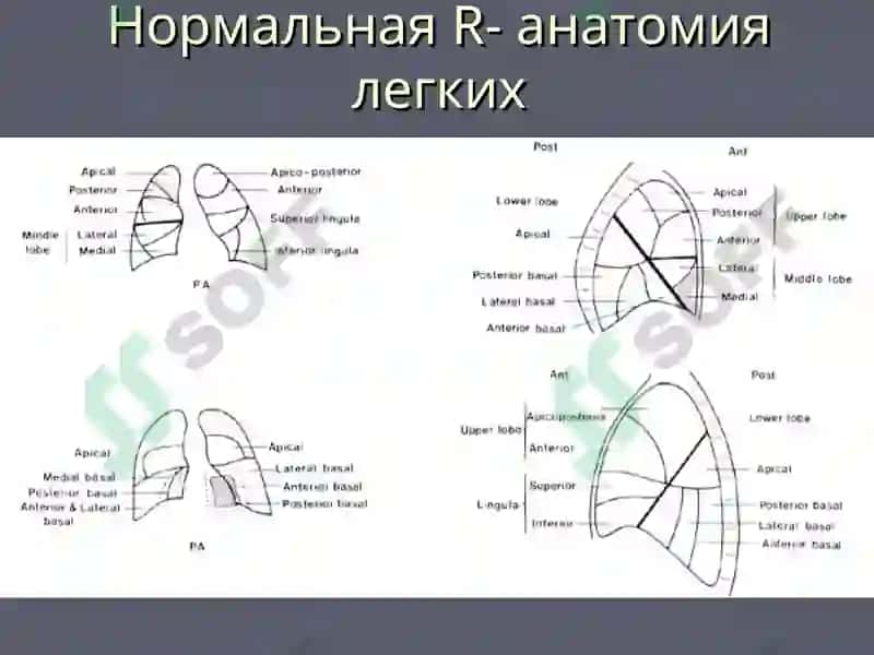 Лучевая диагностика заболеваний легких 4