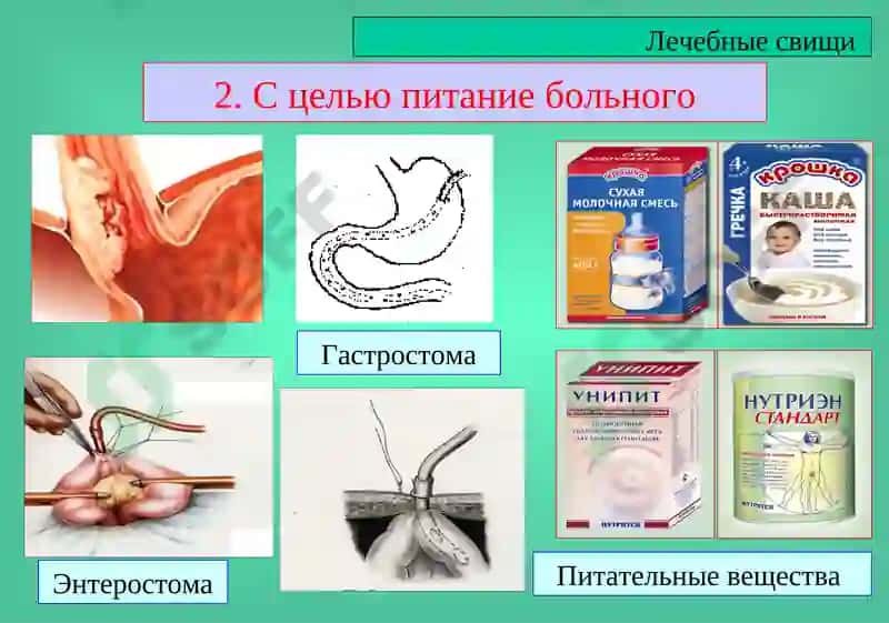 Кишечные свищи 4