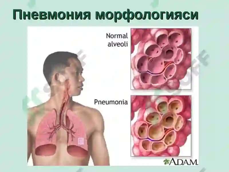 ЎПКА ТЎҚИМАСИНИНГ ЗИЧЛАШИШ СИНДРОМИ 4