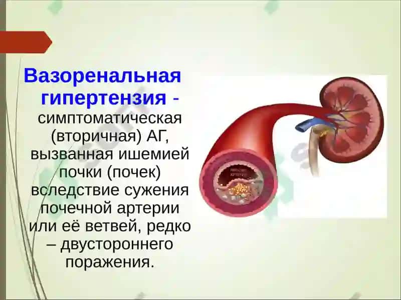 Вазоренальная гипертензия 4