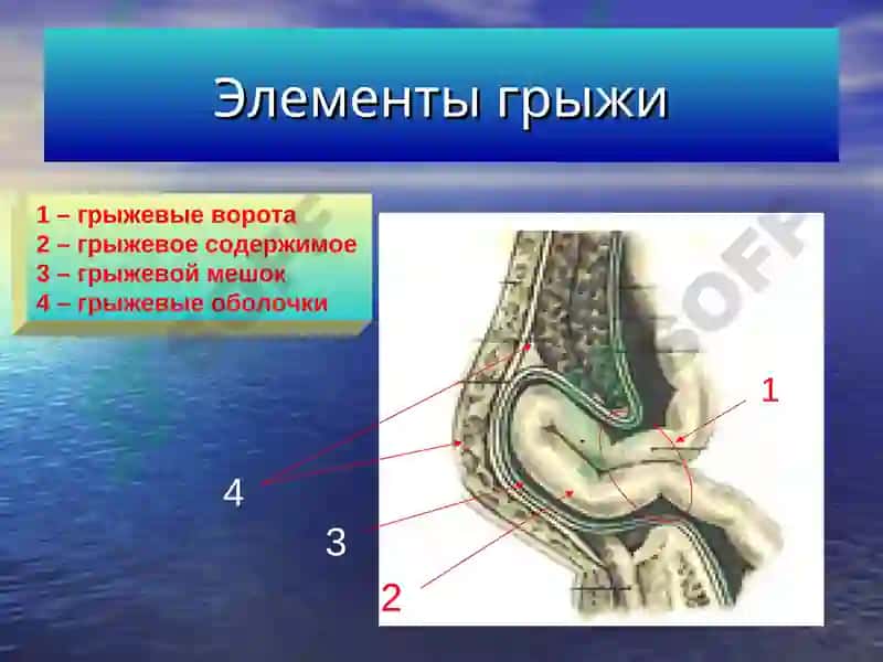 ГРЫЖИ ЖИВОТА 4