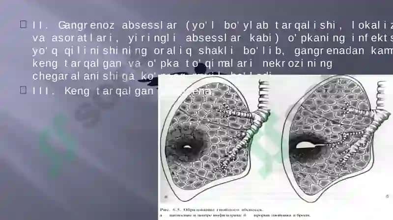 O’PKA ABSESSI VA GANGRENASI ETIOLOGIYASI 4