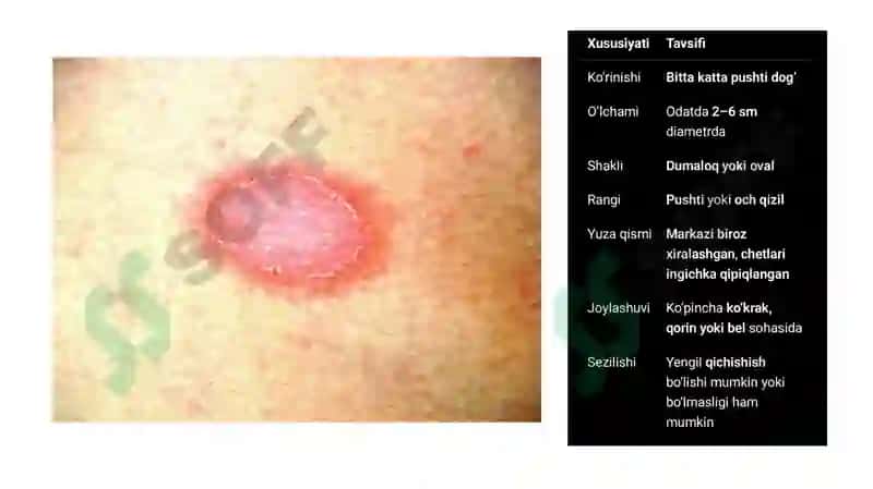 Dermatoveneralogiya: Jeberning pushti rang temiratkisi 4