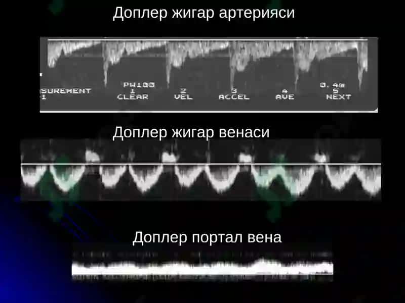 Жигар касалликлари нур ташхиси 4