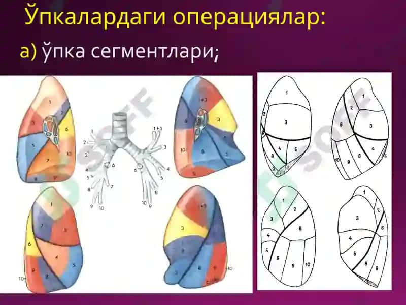 Halsted бўйича радикал мастэктомия 4