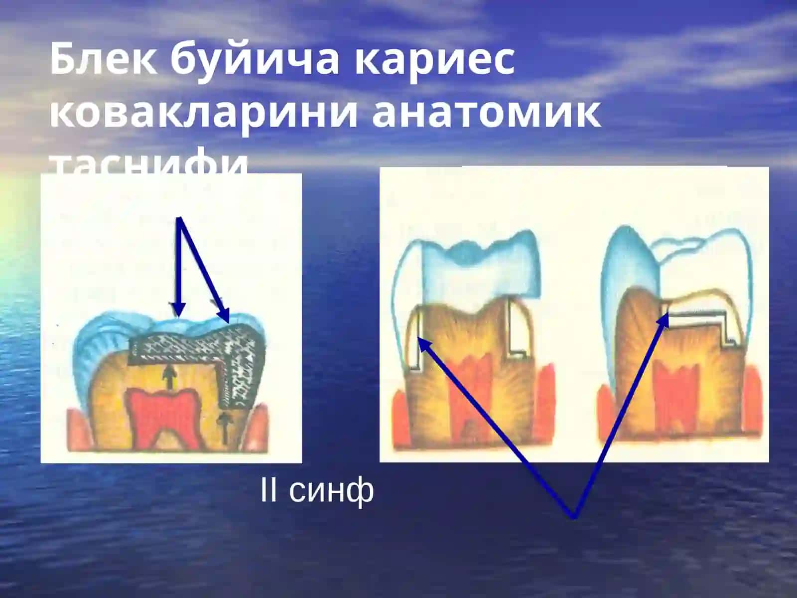 Кариес ковакларини анатомик таснифи 4