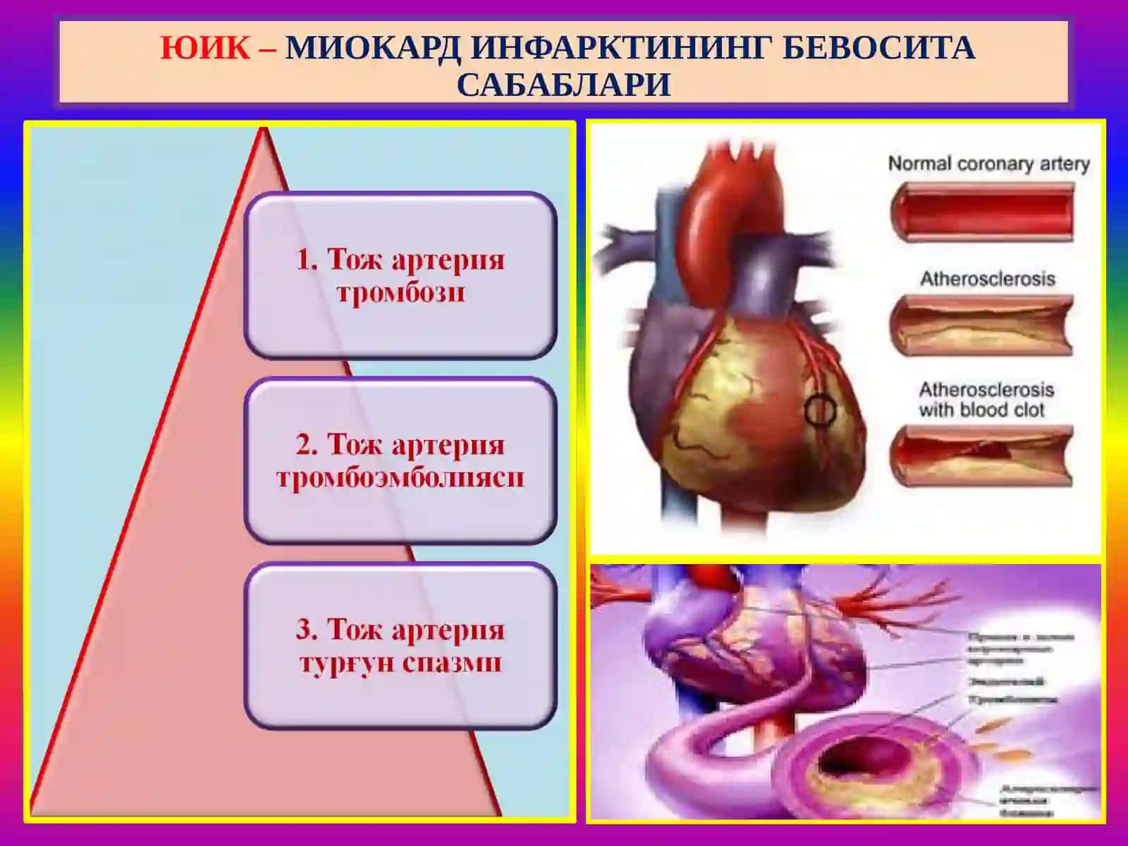 Юрак ишемик касаллиги - ЮИК 4