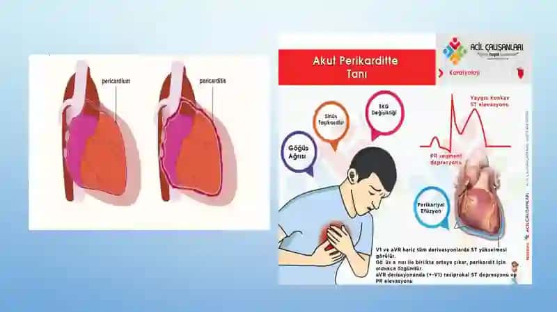 perikard kasalliklari yurak o'smalari yurak transplantatsiyasi 4
