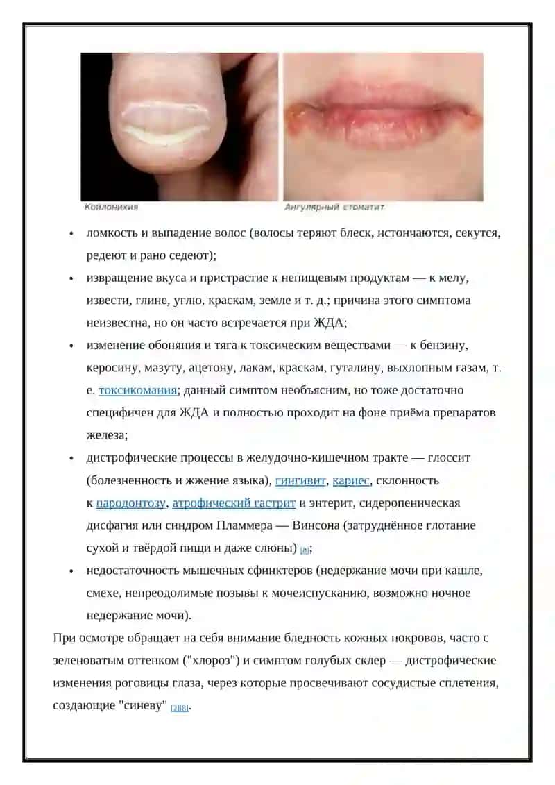 Железодефицитная анемия 4