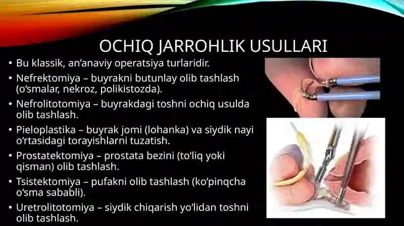 Urologiyada jarrohlik davolash usullari 4