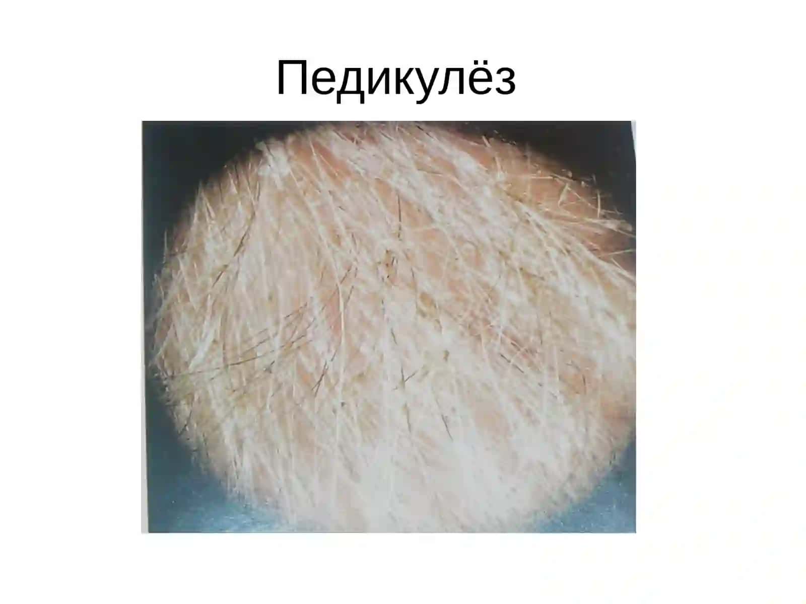 Педикулёз 4