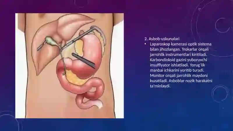 Laparoskopiyaning jarrohlikda qo‘llanishi 4