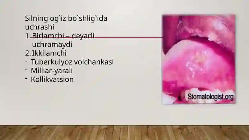 Sil kasalligida og`iz bo`shlig`idagi o`zgarishlar 4