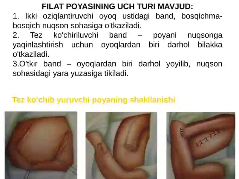 Filatovbandi bilan plastika 4