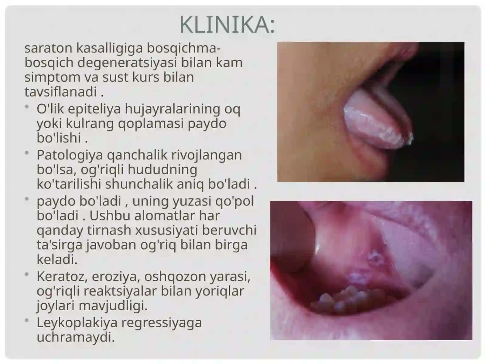 Leykoplakiya. Shakllar. Etiologiya. Davolash. 4