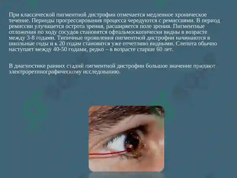 Пигментная дистрофия сетчатки 5