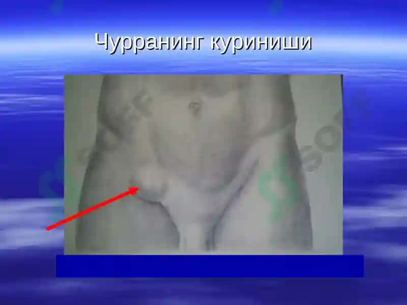 Корин олд девори касаликлари корин олди мускуллари аплозияси 5