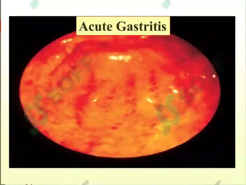 GASTRIT 5