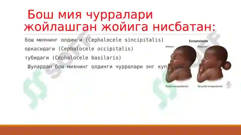 Bosh miya va orqa miyaning tug’ma rivojlanish nuqsonlari 5