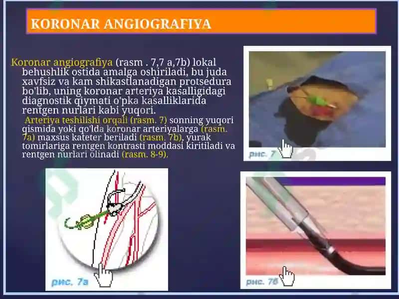 Yurak ishemik kasalliklarini operativ davolashning zamonaviy usullari 5