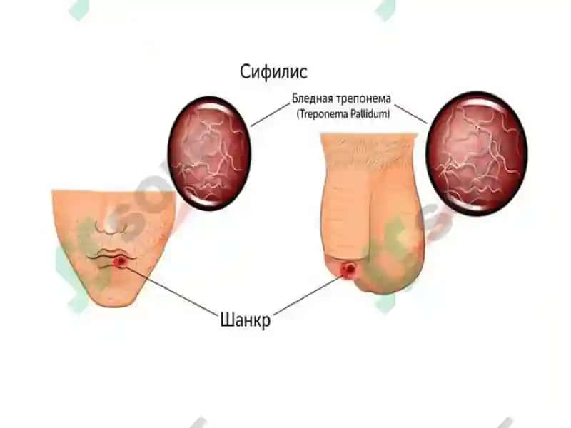 zaxm diagnostikasi - захм диагностикаси 5