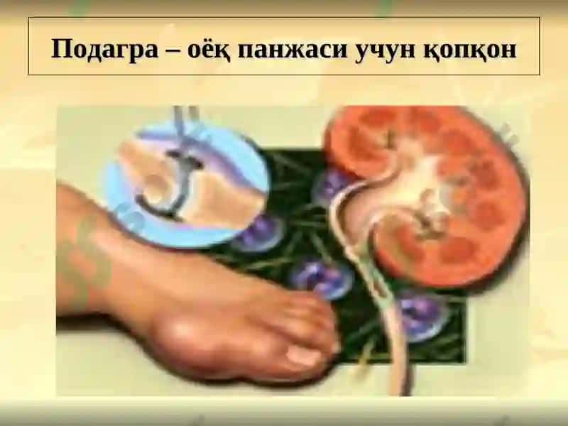 ПОДАГРА 5