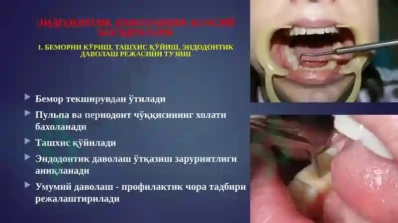 ЭНДОДОНТИК ДАВОЛАШ 5