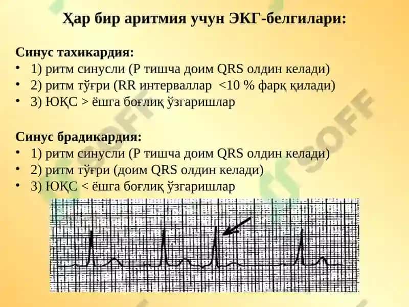 Аритмия ва блокадалар 6