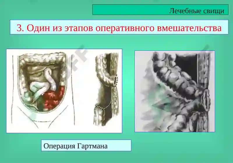 Кишечные свищи 6