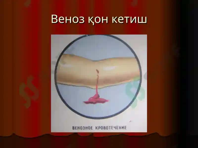 “Қон кетиш ва уни тўхтатиш усуллари” маъруза 6