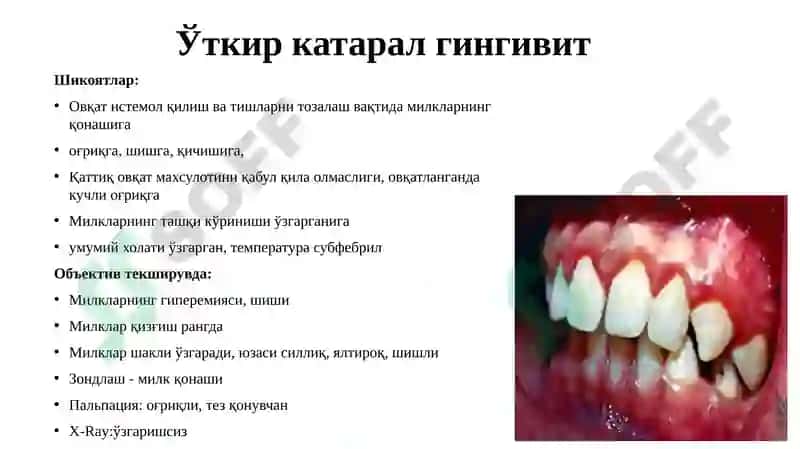 Гингивитлар 6