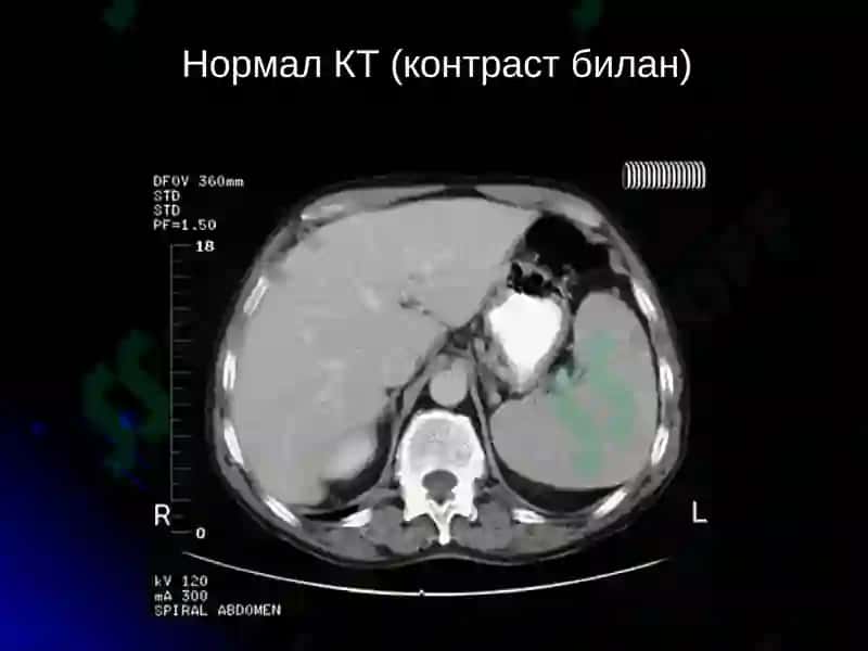 Жигар касалликлари нур ташхиси 6