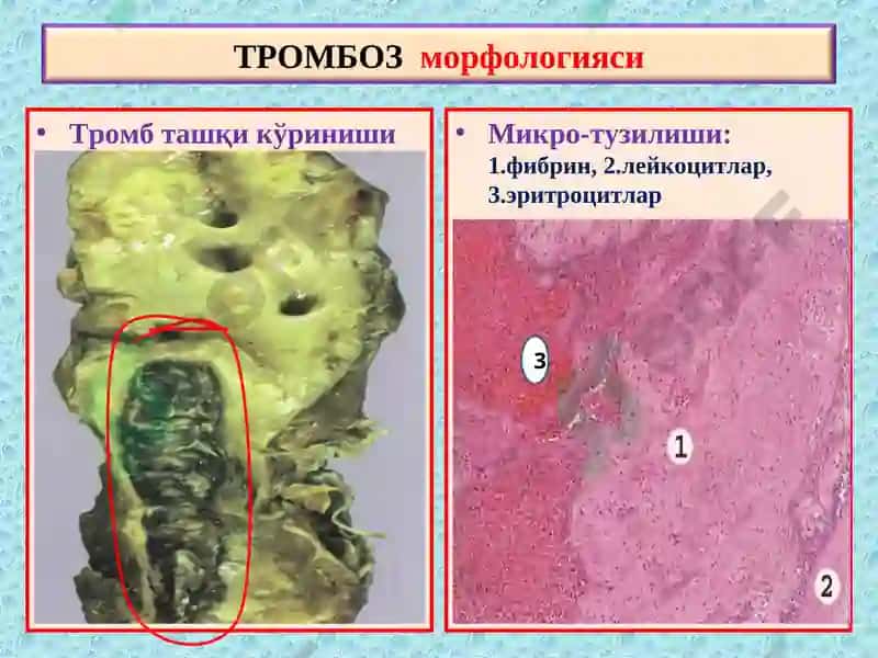 ПАТОЛОГИК АНАТОМИЯ 6