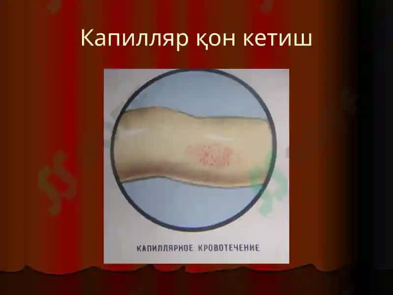 Қон кетиш 6