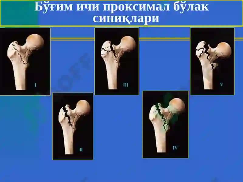 Сон,тизза,болдир ваоёқ панжа шикастлари 6
