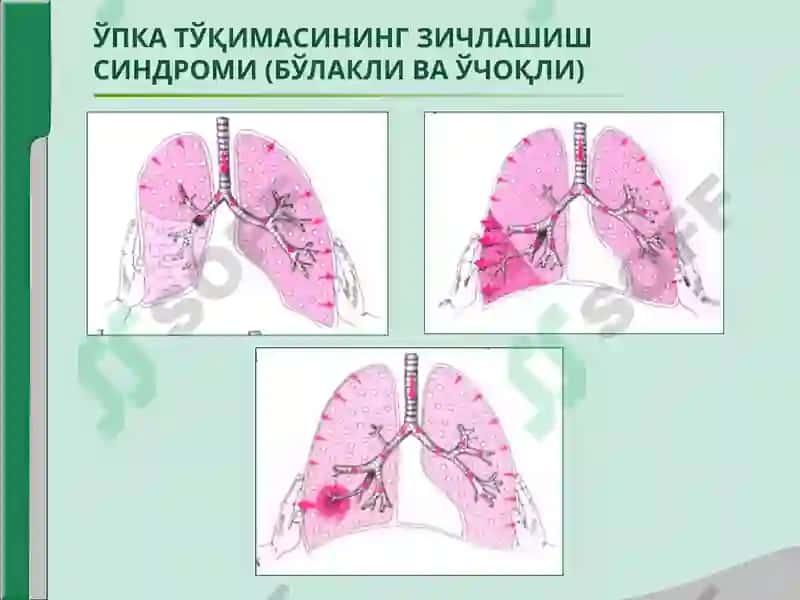 ЎПКА ТЎҚИМАСИНИНГ ЗИЧЛАШИШ СИНДРОМИ 6