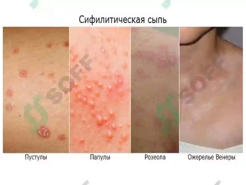 zaxm diagnostikasi - захм диагностикаси 6