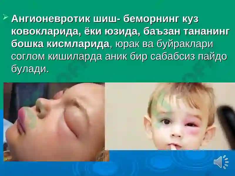 ШИШ СИНДРОМИ ДИФФЕРЕНЦИАЛ ДИАГНОСТИКАСИ. Shish sindromi differensial diagnostikasi 6