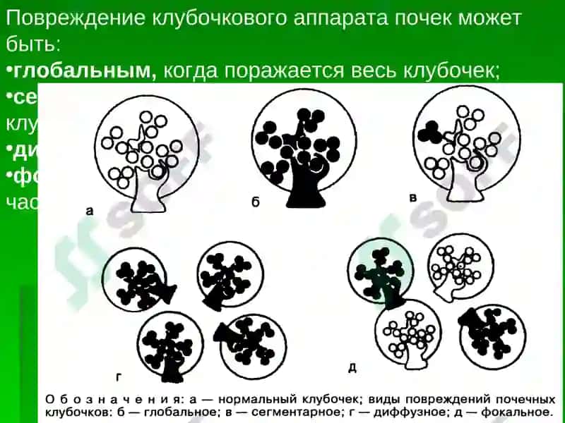Болезни почек 6