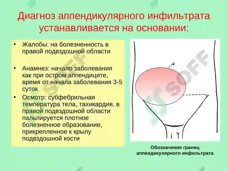 Осложнения острого аппендицита 6