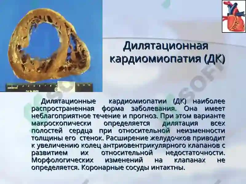КАРДИОМИОПАТИИ 7