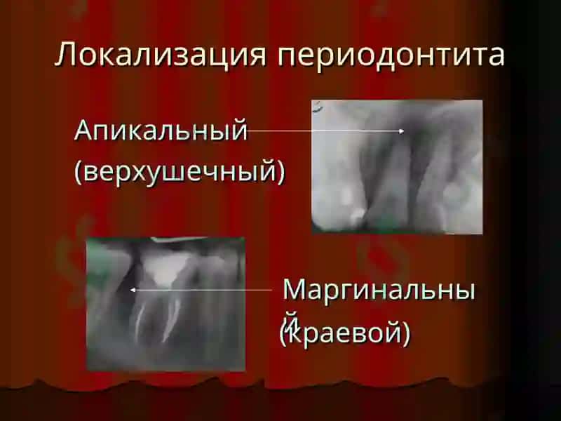 Периодонтит у детей 7