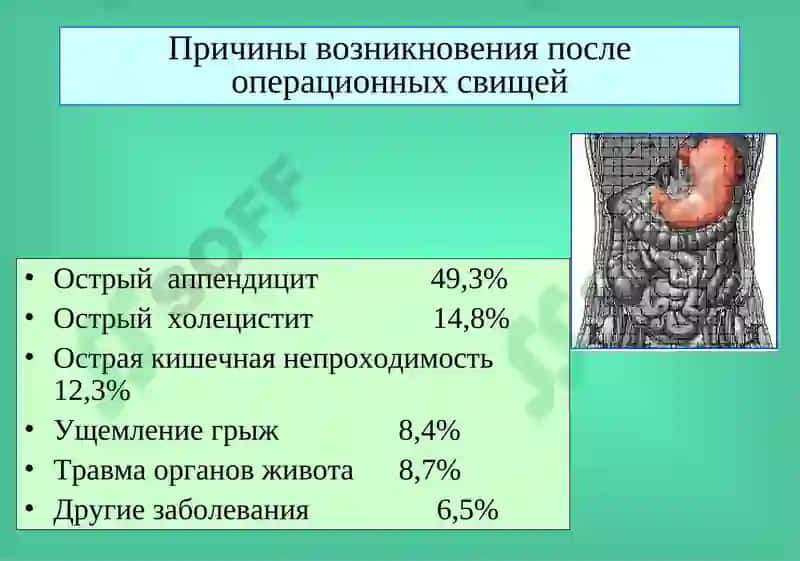 Кишечные свищи 7