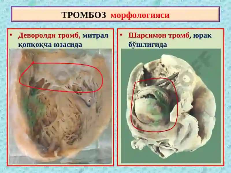 ПАТОЛОГИК АНАТОМИЯ 7
