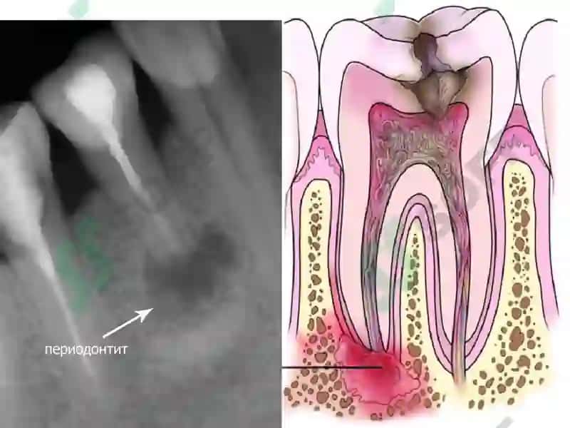 Yosh bolalarda surunkali periodontitlar 7